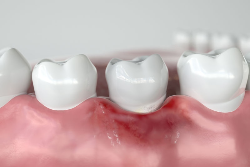 failing dental implant graphic