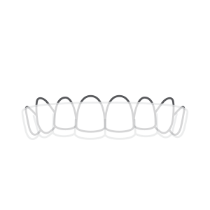 Same-Day Crowns
